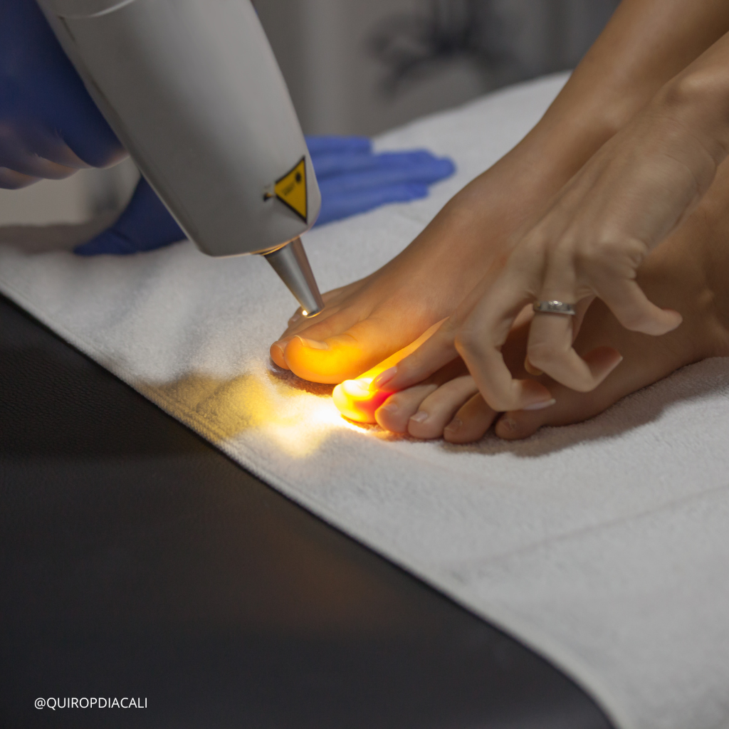 laser podologico laser para hongos en las uñas